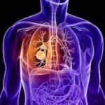 17 de noviembre Dia Mundial de la lucha contra el Cáncer de Pulmón